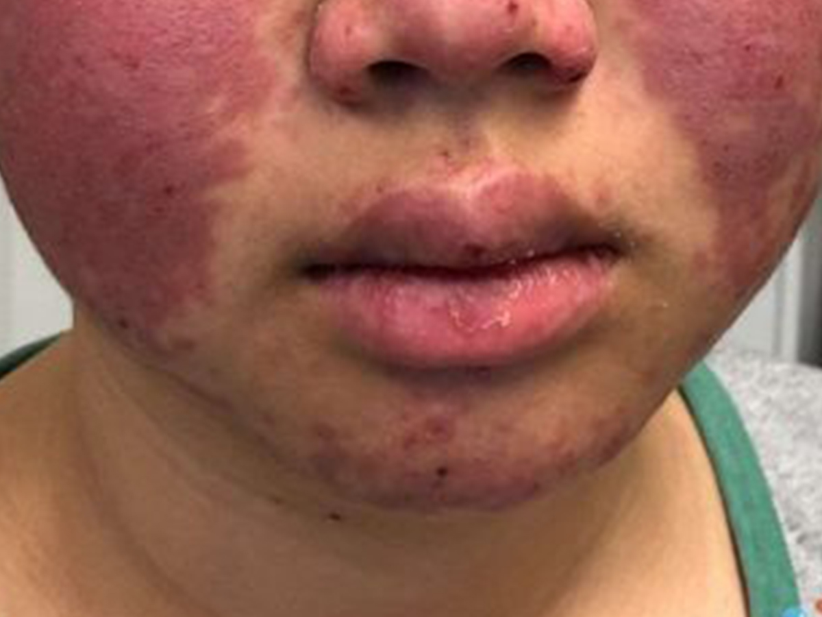 Romatolojik Hastalıklar