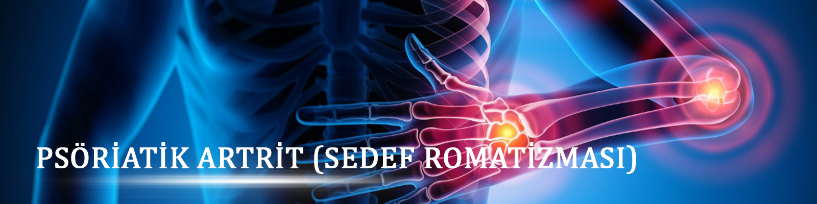 Psöriatik Artrit (Sedef Romatizması)