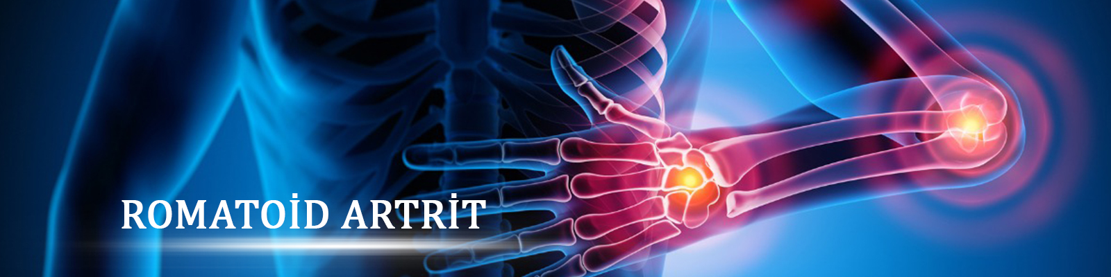 Romatoid Artrit